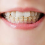乳歯列期・混合歯列期の矯正歯科治療