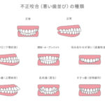 不正咬合の種類と治療法